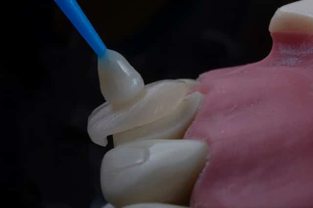 Dental veneer