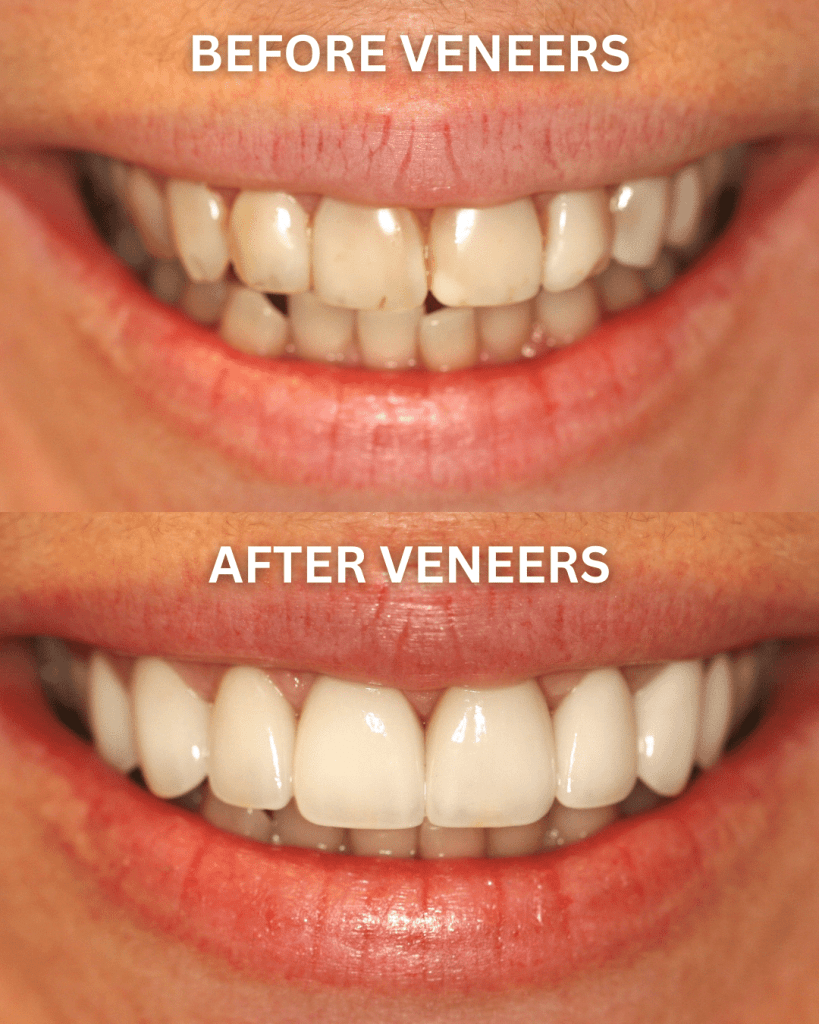 what are veneers