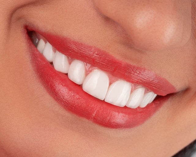 how do veneers work