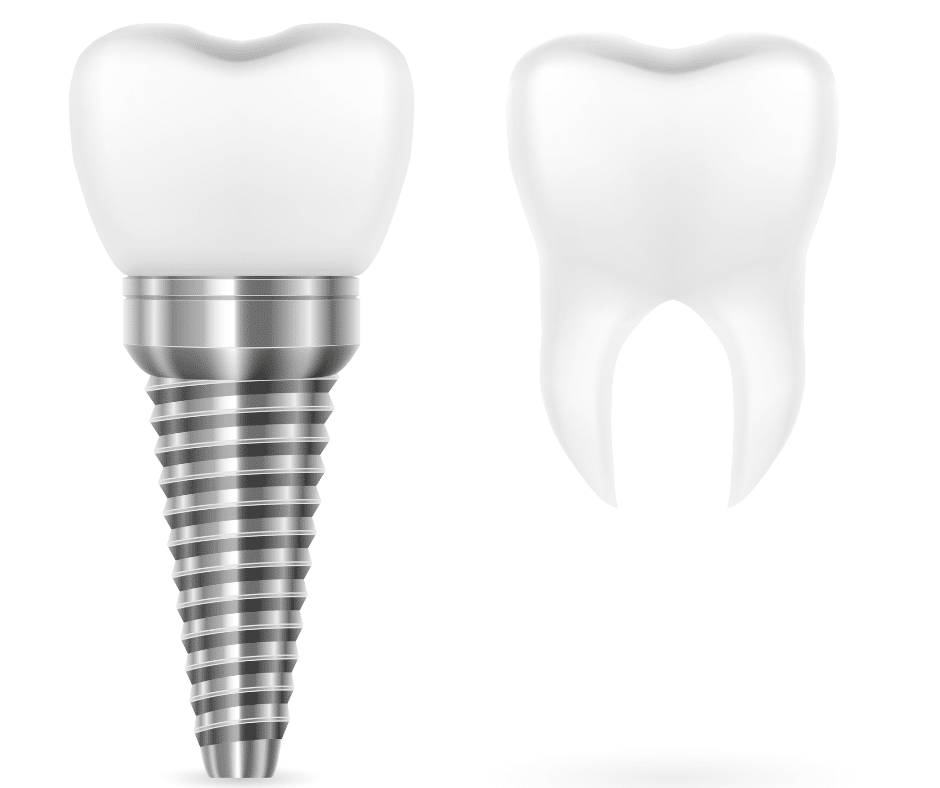 dental implants for missing teeth