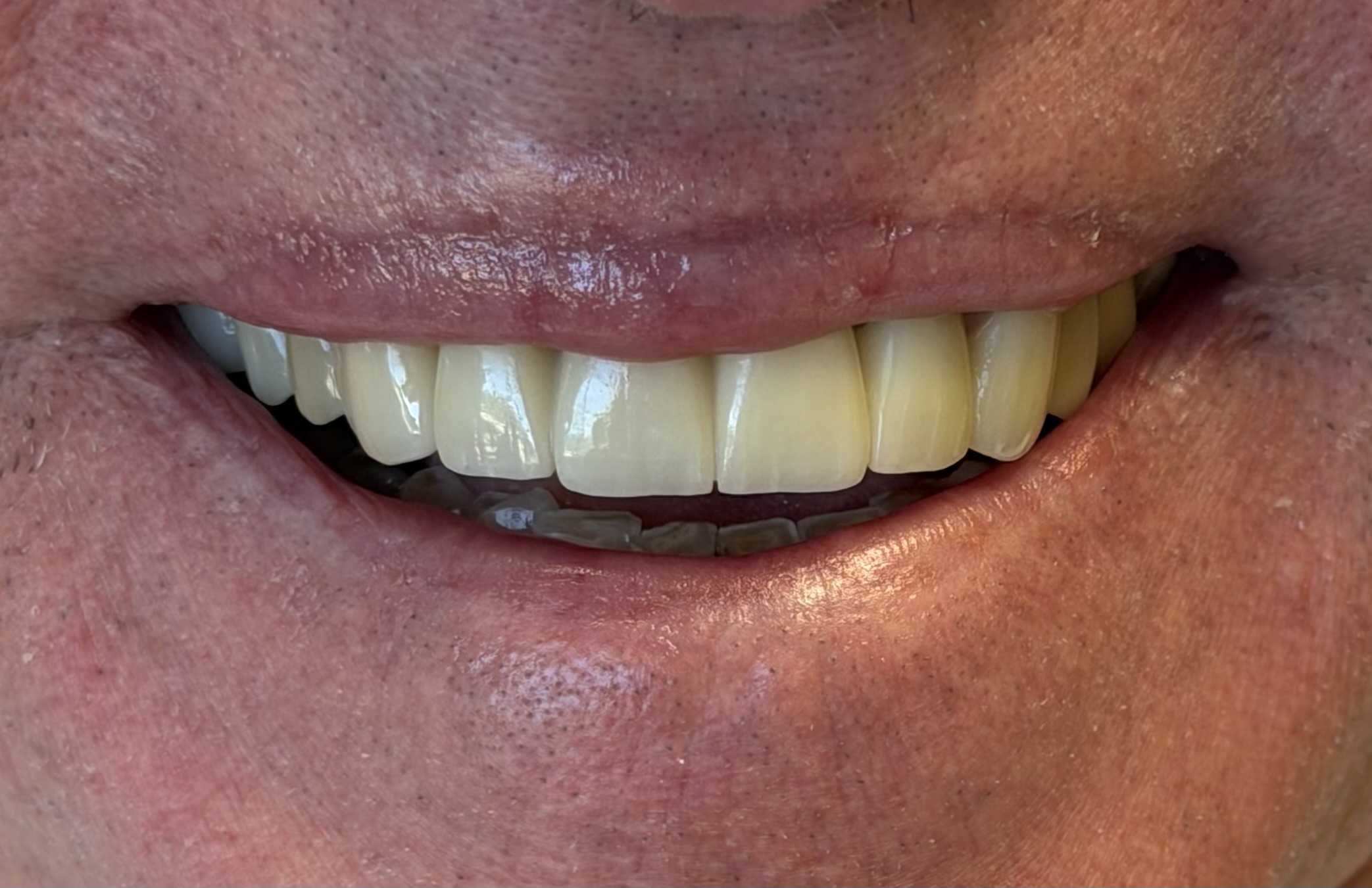 dental crowns after