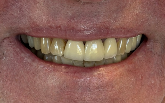 dental crowns before